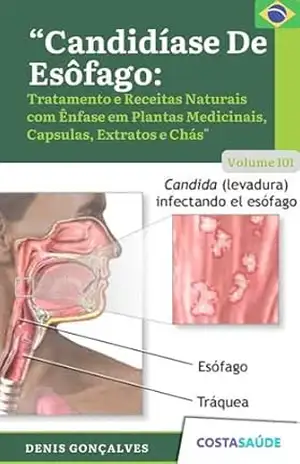 Candidíase De Esôfago: Tratamento Receitas Naturais com Ênfase em Plantas Medicinais, Capsulas, Extratos e Chás – Volume 101 (Tratamento e Receitas Naturais … Capsulas, Extratos e Chás Livro 143) – Denis  Gonçalves