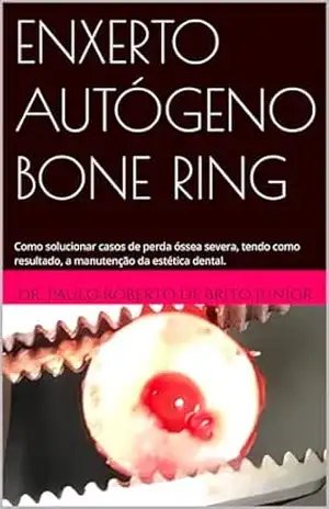 Capa do livro ENXERTO AUTÓGENO BONE RING: Como solucionar casos de perda óssea severa, tendo como resultado, a manutenção da estética dental. - Dr. Paulo Roberto de Brito Junior