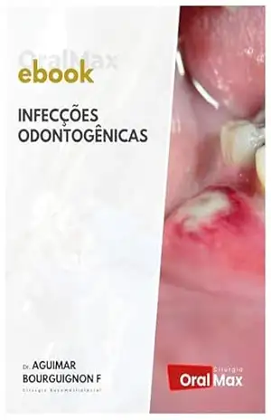 Infecções Odontogênicas – Aguimar de Matos Bourguignon Filho