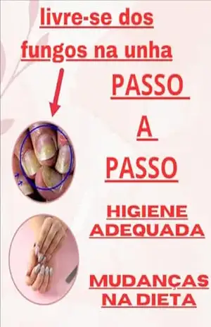 LIVRE–SE DOS FUNGOS NA UNHA – MAX DE SOUZA