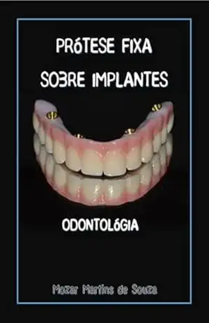 Prótese Fixa sobre Implantes: Prótese Ortodôntica – Mozar Martins