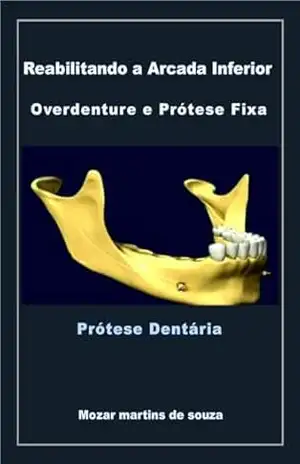 Reabilitando a Arcada Inferior Overdenture e Prótese Fixa: Prótese Odontológica – Mozar Martins